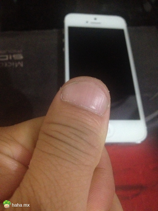 为什么我大拇指指甲长成这样啊?有人知道吗